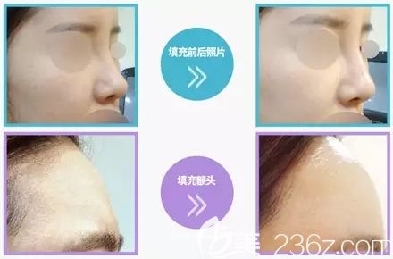 韓國清潭珠顏玻尿酸注射案例 韓國清潭珠顏玻尿酸注射案例