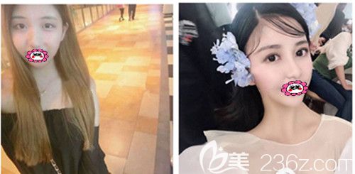 符恒雙眼皮前后效果圖 符恒雙眼皮前后效果圖