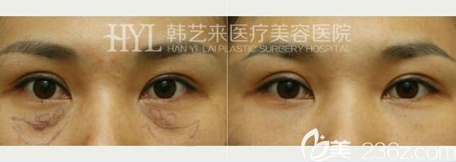 佳木斯韓藝來祛眼袋效果
