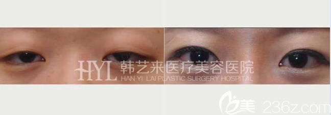 佳木斯韓藝來上眼瞼下垂效果對(duì)比