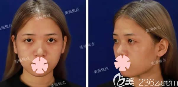 我在桂林美麗焦點整形做自體脂肪填充前照片 我在桂林美麗焦點整形做自體脂肪填充前照片