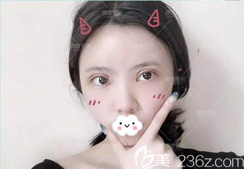 雙眼皮面部填充術后5天