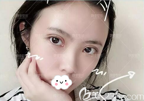 切開雙眼皮+脂肪面填10天恢復效果