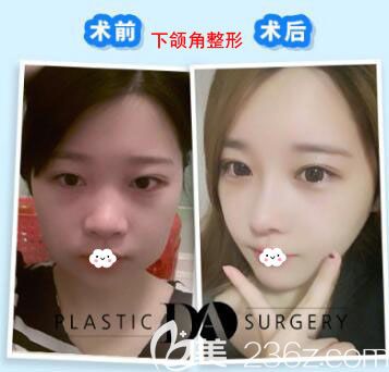 韓國DA醫(yī)院院長去下頜角案例效果對比力圖