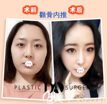這是韓國DA整形醫(yī)院顴骨內(nèi)推案例