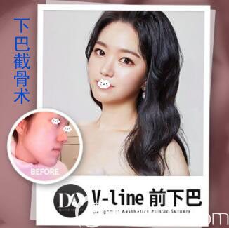 韓國DA整形下巴截短整形案例