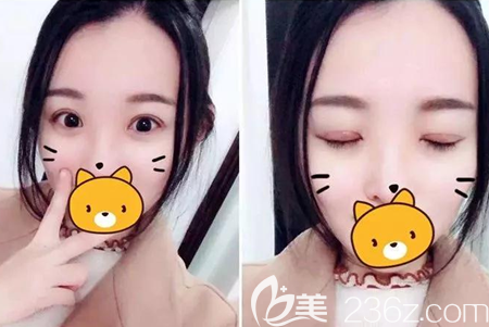 楊林切開雙眼皮微創(chuàng)開眼角45天 楊林切開雙眼皮微創(chuàng)開眼角45天