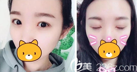 廣元美華整形美容醫(yī)院雙眼皮開眼角3個月恢復(fù)照 廣元美華整形美容醫(yī)院雙眼皮開眼角3個月恢復(fù)照