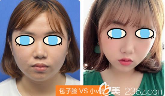 福州美貝爾<!--<i data=20240703-sp></i>-->面部吸脂對比效果圖