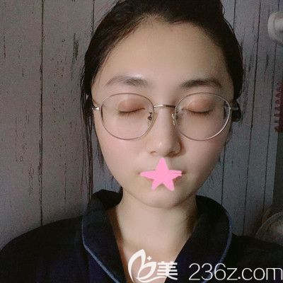 武漢壹加壹王政祥主任面部線雕提升術(shù)后4天效果圖