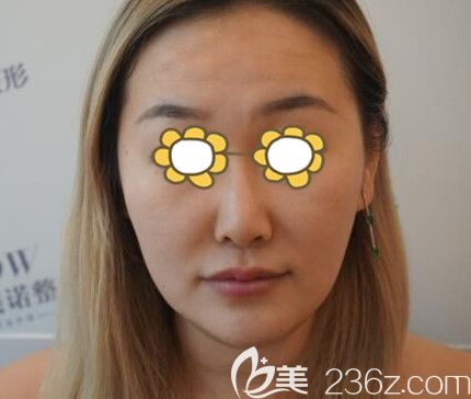 做線雕術(shù)前照 做線雕術(shù)前照