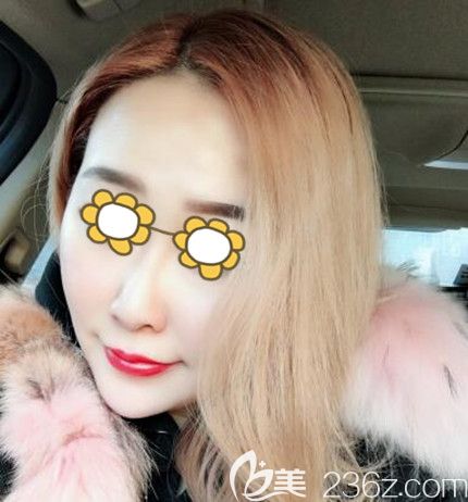 面部埋線提升術(shù)后30天效果 面部埋線提升術(shù)后30天效果