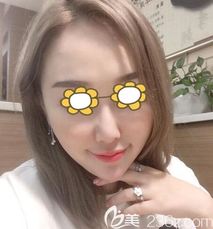 面部埋線提升術(shù)后60天效果 面部埋線提升術(shù)后60天效果