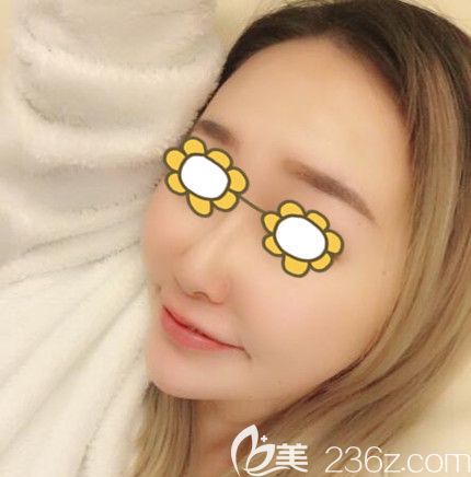 做埋線提升術(shù)后90天效果 做埋線提升術(shù)后90天效果