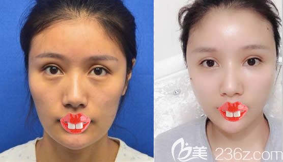 美貝爾趙主任全臉自體脂肪填充前后對比效果