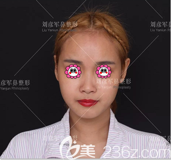 在北京沃爾醫(yī)療美容診所做肋軟骨隆鼻前樣子 在北京沃爾醫(yī)療美容診所做肋軟骨隆鼻前樣子