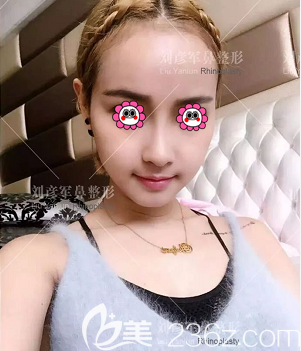 在北京沃爾整形做肋軟骨鼻綜合第14天<span style= 在北京沃爾整形做肋軟骨鼻綜合第14天<span style=