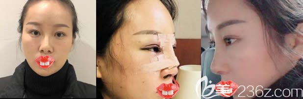 福州美貝爾趙棟材肋軟骨隆鼻前后對比照