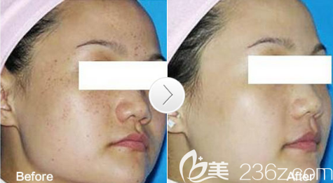 廣元醫(yī)而美美華趙艷王者之風(fēng)去雀斑案例