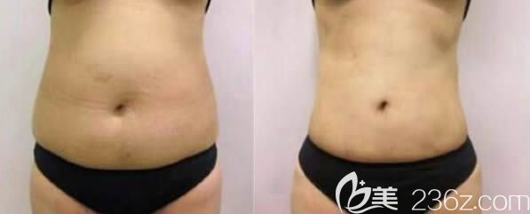 趙棟材醫(yī)生腰腹吸脂前后對比案例