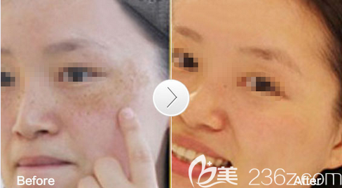 廣元美華趙艷黃褐斑治療效果