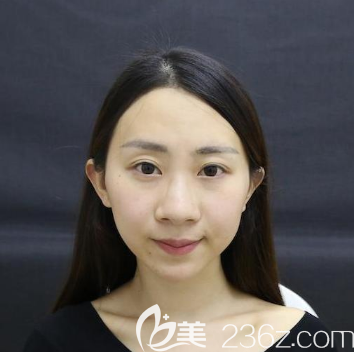 術前大鼻頭的照片 術前大鼻頭的照片