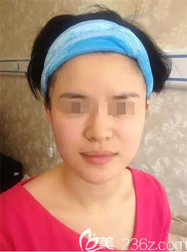 對(duì)比沒做和做的臉美國OPT復(fù)合彩光效果 對(duì)比沒做和做的臉美國OPT復(fù)合彩光效果