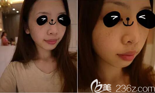 光子祛斑治療前照片