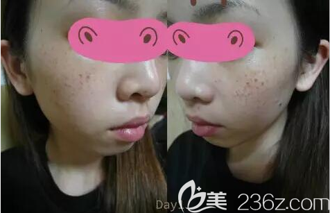 光子祛斑后臉上結(jié)痂