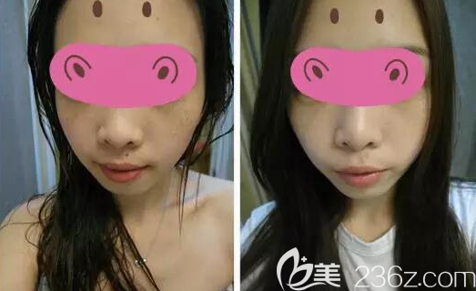 廣元美華光子祛雀斑治療后效果對(duì)比