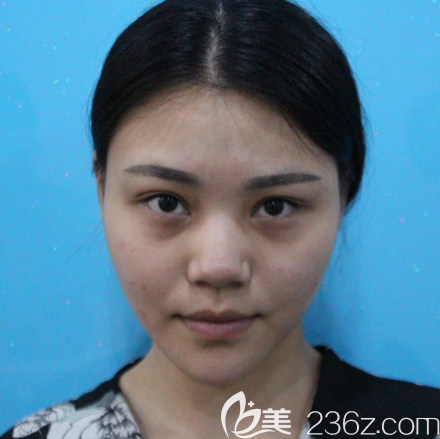 術(shù)前塌鼻照片 術(shù)前塌鼻照片