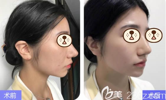 福州美貝爾整形醫(yī)院薛欣醫(yī)生玻尿酸豐下巴前后對比效果