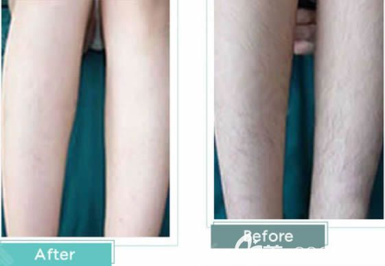 福州美貝爾陳蕓珊小腿脫毛前后對比效果