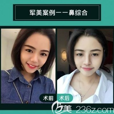 廣州軍美王世虎隆鼻<span style=