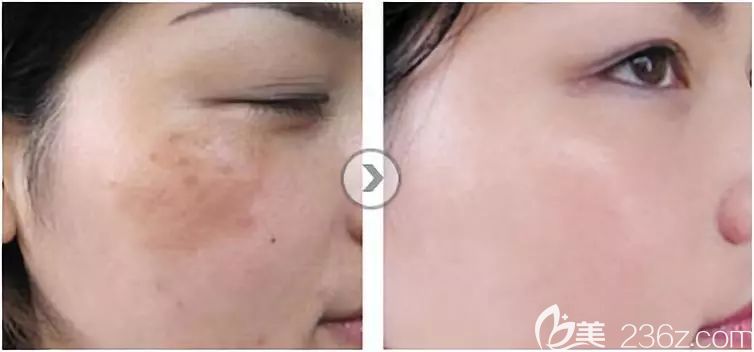 趙亮醫(yī)生祛斑前后對(duì)比照 趙亮醫(yī)生祛斑前后對(duì)比照