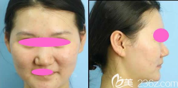 沒去贛州亞韓整形醫(yī)院做鼻綜合手術(shù)前的我 沒去贛州亞韓整形醫(yī)院做鼻綜合手術(shù)前的我