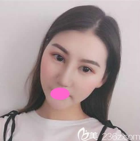 去贛州亞韓整形醫(yī)院做鼻綜合手術(shù)第7天照片 去贛州亞韓整形醫(yī)院做鼻綜合手術(shù)第7天照片