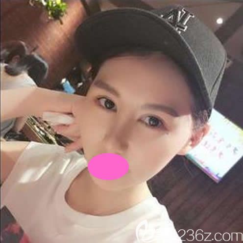 贛州隆鼻哪里好?看我找贛州亞韓“金鼻子”金輝做鼻綜合手術(shù)1-7天的照片