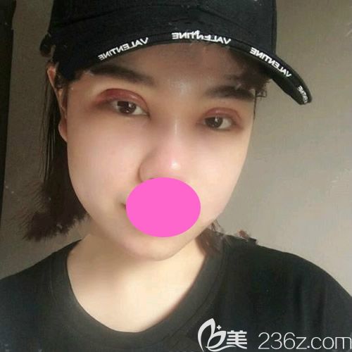 找<!--<i data=20240703-sp></i>-->整形醫(yī)院孫守縣做全切雙眼皮手術(shù)第2天<span style=