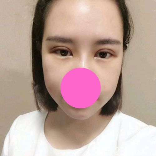 找<!--<i data=20240703-sp></i>-->整形醫(yī)院孫守縣做全切雙眼皮手術(shù)第7天<span style=