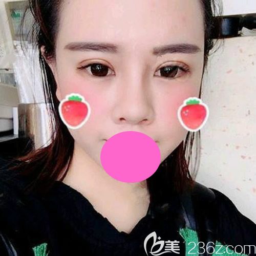 找<!--<i data=20240703-sp></i>-->整形醫(yī)院孫守縣做全切雙眼皮手術(shù)第18天樣子