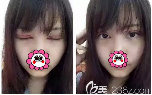 找常熟時(shí)代醫(yī)生剛做完雙眼皮+開(kāi)眼角+去皮去脂 找常熟時(shí)代醫(yī)生剛做完雙眼皮+開(kāi)眼角+去皮去脂