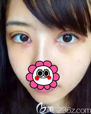 做完眼綜合術(shù)后第三天恢復(fù)情況 做完眼綜合術(shù)后第三天恢復(fù)情況