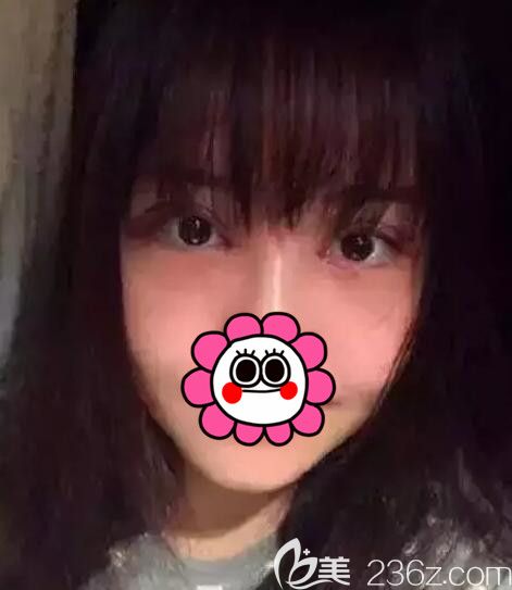 常熟時(shí)代分享眼綜合術(shù)后一周拆線恢復(fù) 常熟時(shí)代分享眼綜合術(shù)后一周拆線恢復(fù)