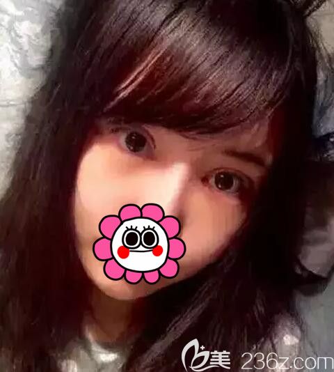 做完雙眼皮開(kāi)眼角去皮去脂術(shù)后半個(gè)月恢復(fù)情況 做完雙眼皮開(kāi)眼角去皮去脂術(shù)后半個(gè)月恢復(fù)情況