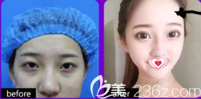 石家莊天伊美雙眼皮案例