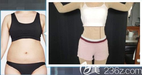 天伊美整形醫(yī)院做腰腹吸脂案例