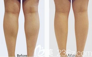 石家莊天伊美注射瘦腿案例