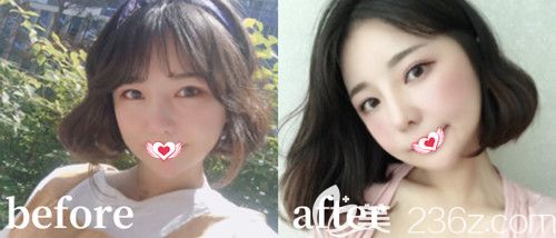 張柏松院長做雙眼皮案例 張柏松院長做雙眼皮案例