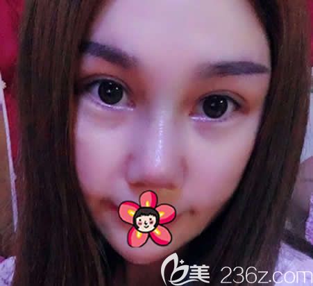 金華亞美做鼻修復(fù)和雙眼皮<span style=